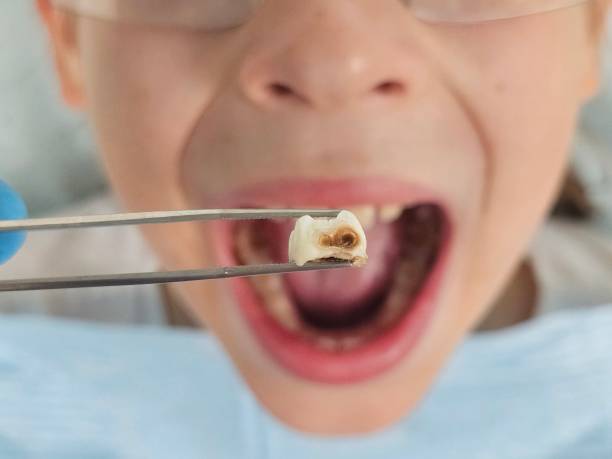 Best Emergency Tooth Extraction in Wilton Center, CT