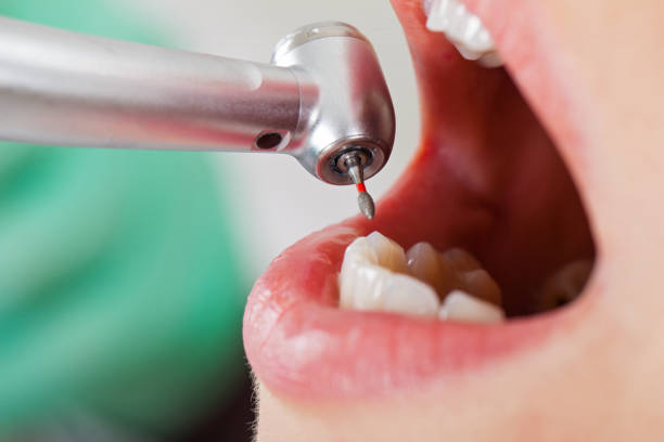 Best Emergency Root Canal Treatment in Wilton Center, CT